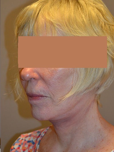 after facelift left angle view of female patient 1642