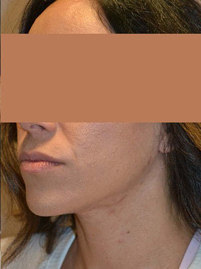 after facelift left angle view of female patient 1648