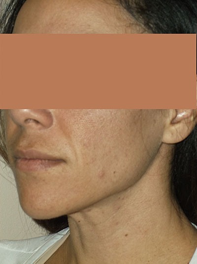 before facelift left angle view of female patient 1648