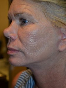 after facelift left side view of female patient 1667