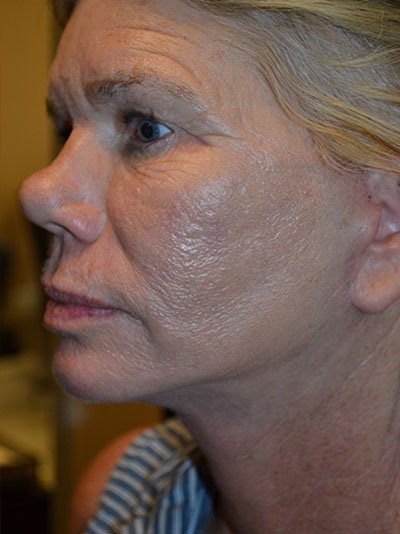 after facelift left side view of female patient 1667
