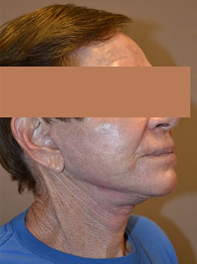 after facelift right angle view of patient 1673