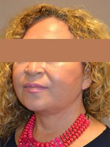 after facelift left angle view of female patient 26