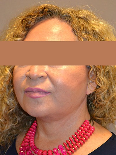 after facelift left angle view of female patient 26