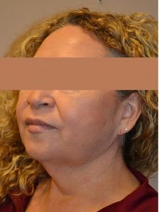 before facelift left angle view of female patient 26