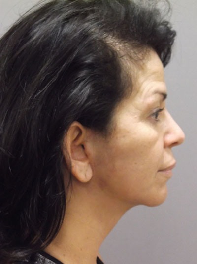 after facelift right side view of female patient 27