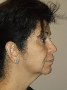 before facelift right side view of female patient 27