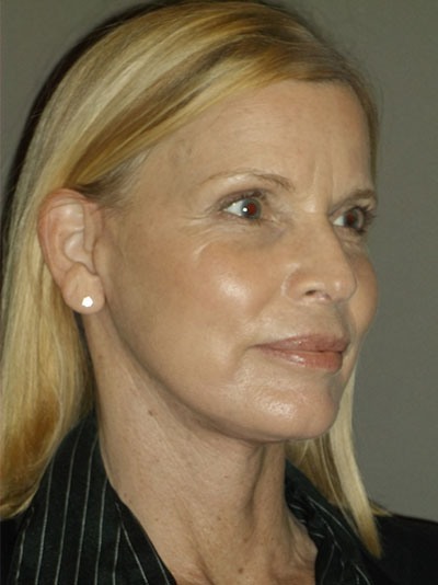 after facelift right angle view of female patient 28