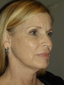 before facelift right angle view of female patient 28