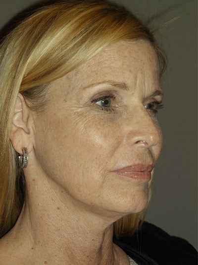 before facelift right angle view of female patient 28