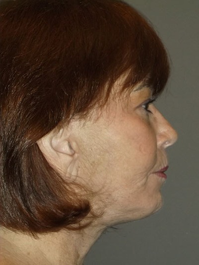 before facelift right side view of female patient 1730