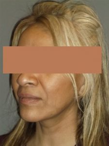 after facelift left angle view of female patient 1745