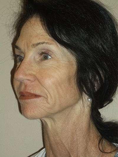 before facelift left angle view of female patient 1759