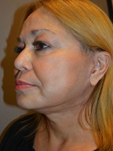 after facelift left angle view of female patient 1848