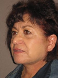 after facelift left angle view of female patient 1860