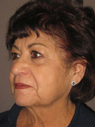 before facelift left angle view of female patient 1860