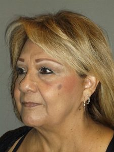 before facelift left angle view of female patient 1866