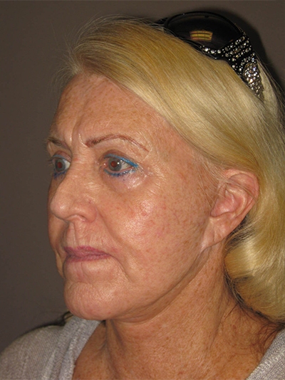 before facelift left angle view female patient case 1904