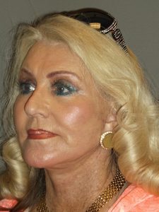 after facelift left angle view female patient case 1904