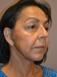 after facelift front right angle view female patient case 1908