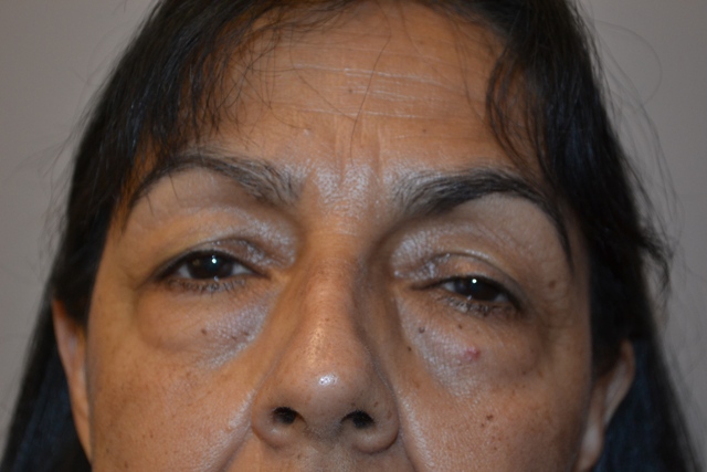 before facelift front closeup view female patient case 1908