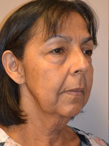 before facelift right angle view female patient case 1908