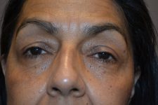 after facelift front closeup view female patient case 1908