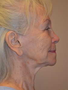 before facelift right side view female patient case 1929