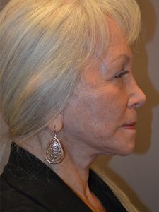 after facelift right side view female patient case 1929