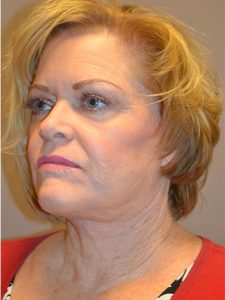 after facelift left angle view female patient case 1953