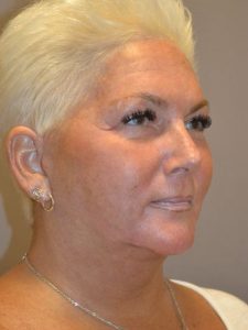 after facelift right angle view female patient case 1976