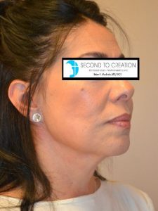 before facelift right angle view female patient case 1987