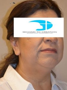 before facelift right angle view female patient 43