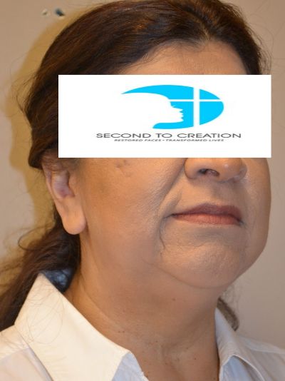 before facelift right angle view female patient 43