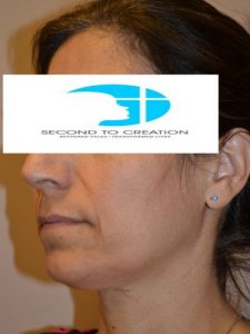 before facelift left angle view female patient case 45