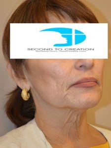 before facelift right angle view female patient case 46