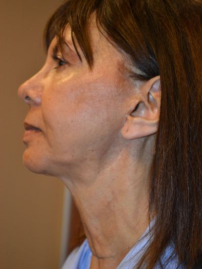 after facelift left view female patient case 47