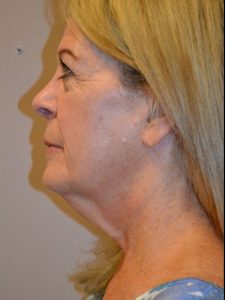 before facelift left view female patient case 48
