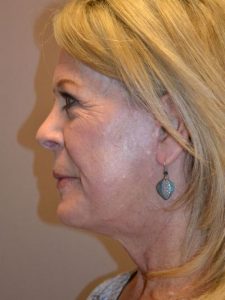 after facelift left view female patient case 48