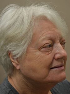 after facelift right angle view female patient case 49