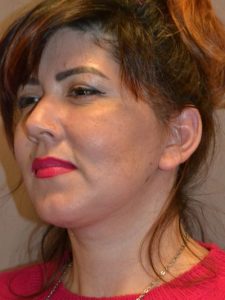 after facelift left angle view female patient case 51