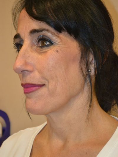 before facelift left angle view female patient case 53