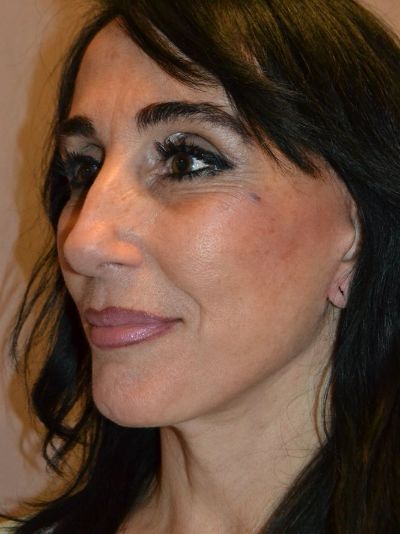 after facelift left angle view female patient case 53