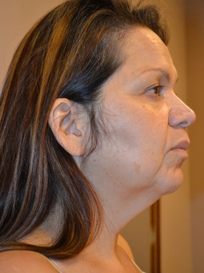 before facelift right view female patient case 54