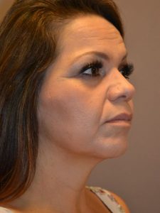 after facelift right angle view female patient case 54