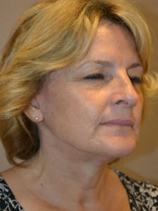 after facelift right angle view female patient case 55