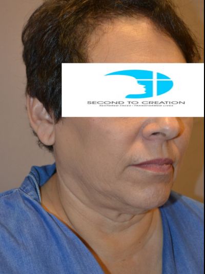 before facelift right angle view female patient case 57