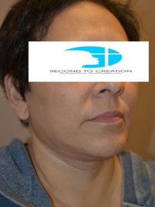 after facelift right angle view female patient case 57