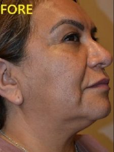 before facelift right side view of female patient case 2683