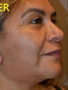 after facelift right side view of female patient case 2683